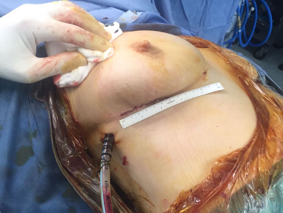  Cardiochirurgia in Montevergine. Diminuisce la mortalitÃ , tasso allâ€™1,5 %