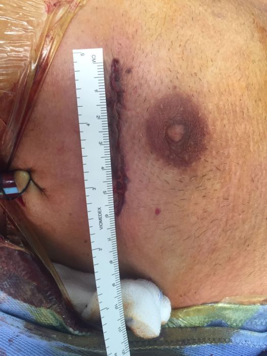  Cardiochirurgia in Montevergine. Diminuisce la mortalitÃ , tasso allâ€™1,5 %