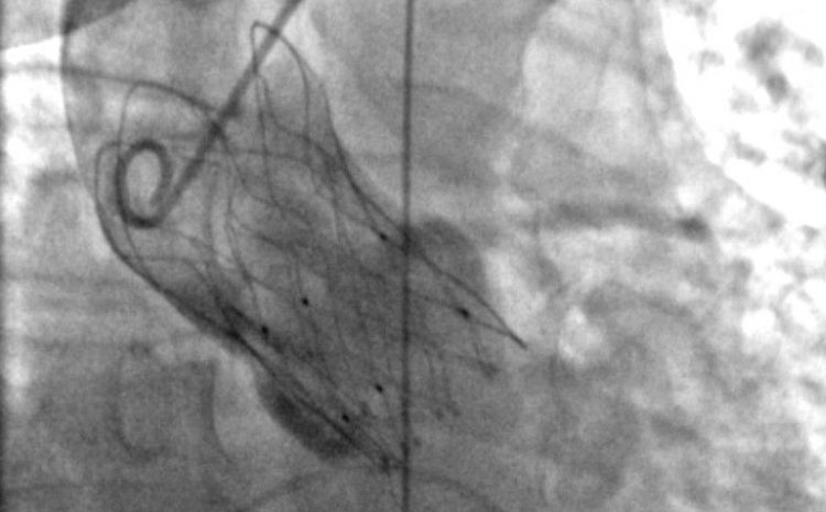  Clinica Montevergine: primo centro in Italia ad aver impiantato una protesi valvolare innovativa per il trattamento non invasivo della stenosi aortica