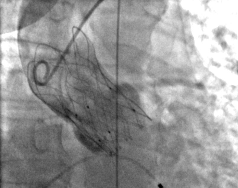  Clinica Montevergine: primo centro in Italia ad aver impiantato una protesi valvolare innovativa per il trattamento non invasivo della stenosi aortica