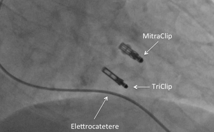  L’insufficienza della valvola tricuspide si risolve con la triclip alla Clinica Montevergine, anche in casi complessi