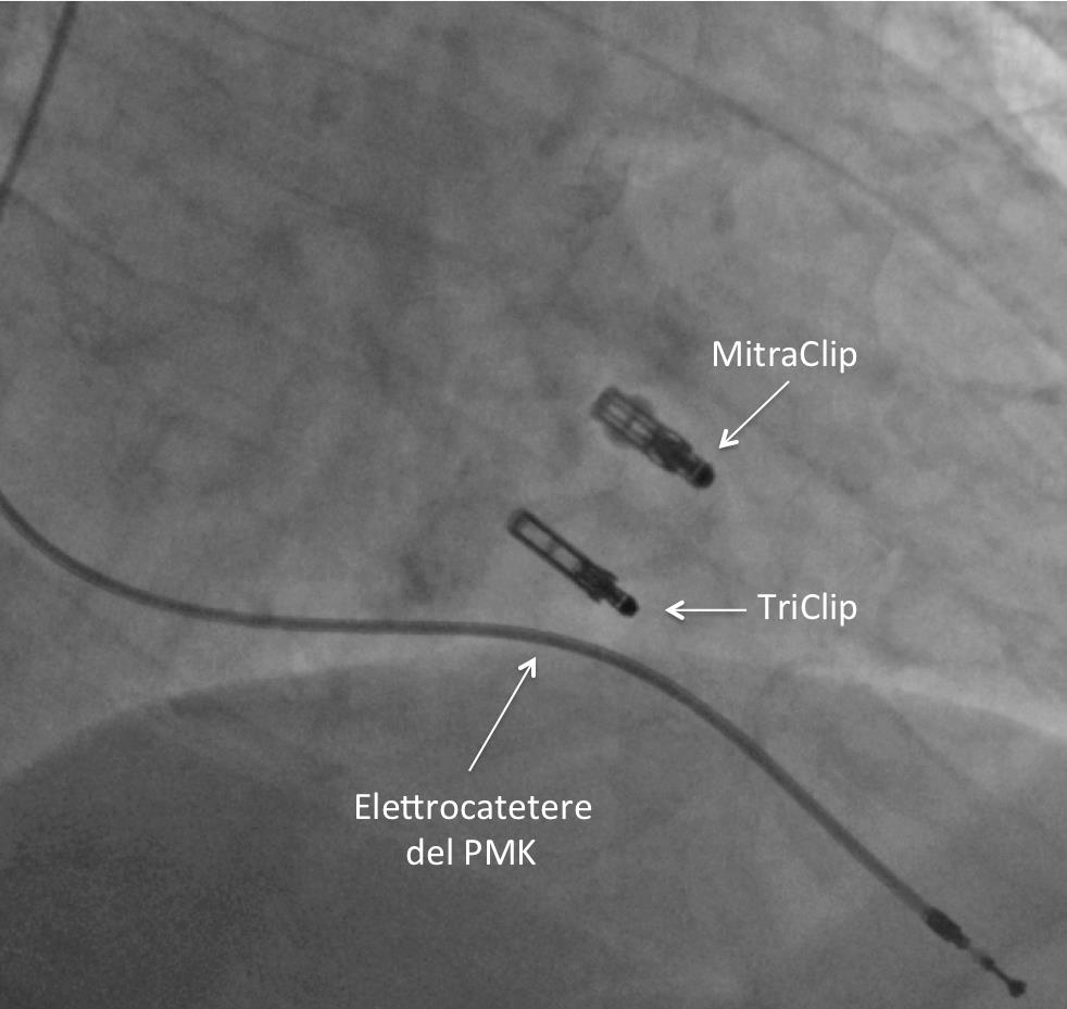  L’insufficienza della valvola tricuspide si risolve con la triclip alla Clinica Montevergine, anche in casi complessi