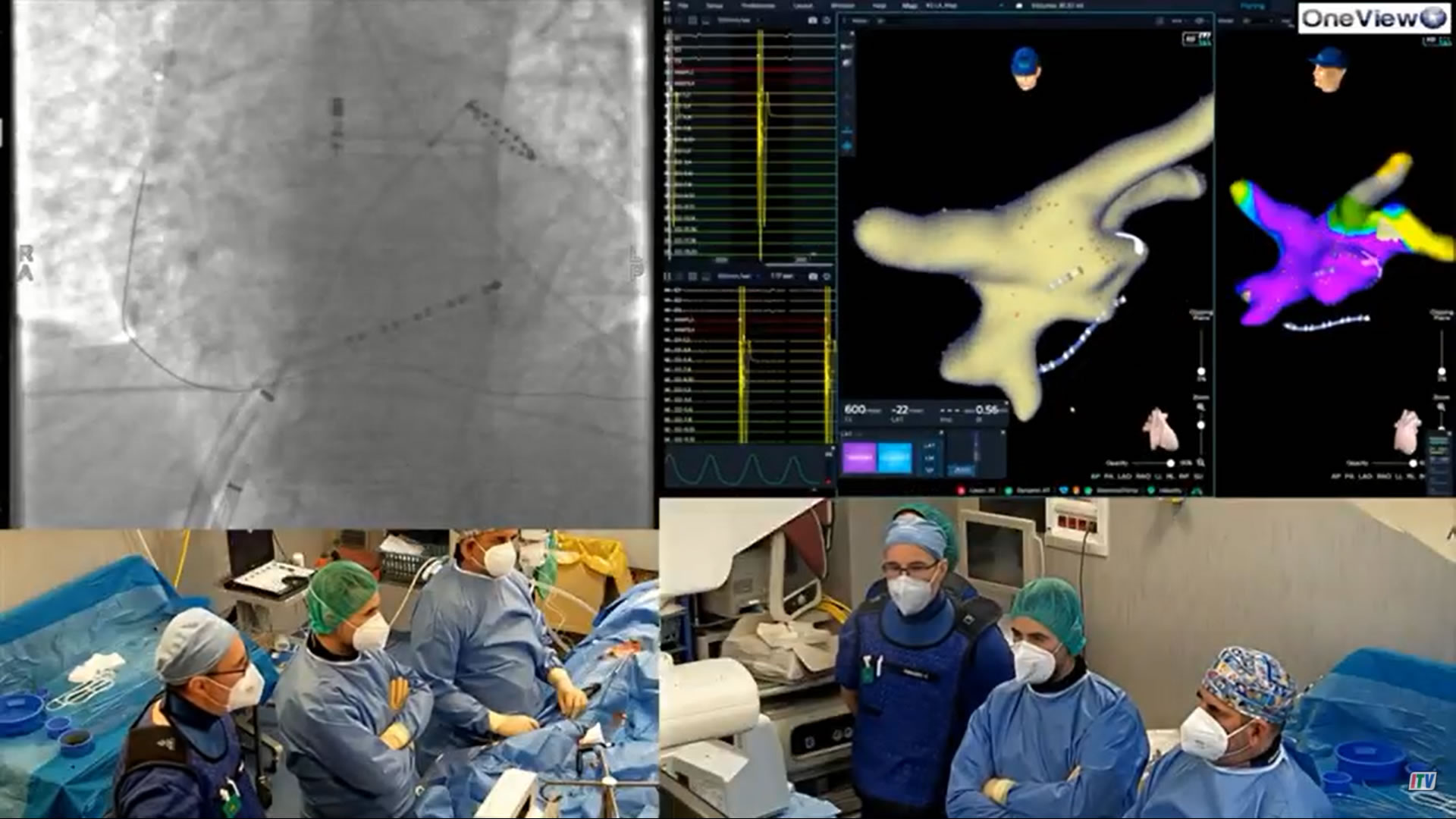  Alla clinica Montevergine, nuova tecnologia per l’ablazione della fibrillazione atriale